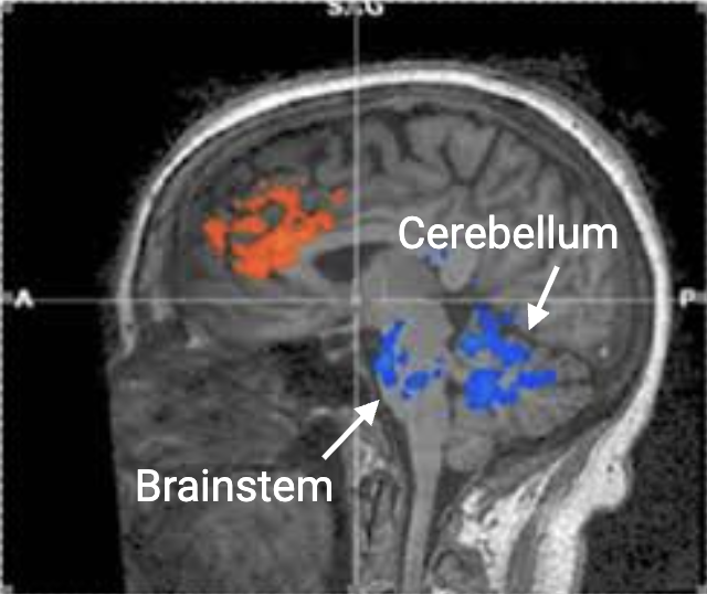 This is the image of a brain fMRI showing higher activity in the prefrontal cortex and lower activity in the brainstem and cerebellum.