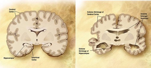 Healthy Brain vs Damaged and Shrunken Dementia Brain with decreased size in cortex and hippocampus.
