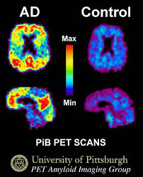 This image shows a PiB-PET scan of a patient with Alzheimer's disease on the left and an elderly person with normal memory on the right. Areas of red and yellow show high concentrations of PiB in the brain and suggest high amounts of amyloid deposits in these areas.