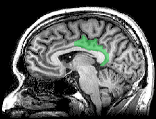 Medial view of the posterior cingulate cortex