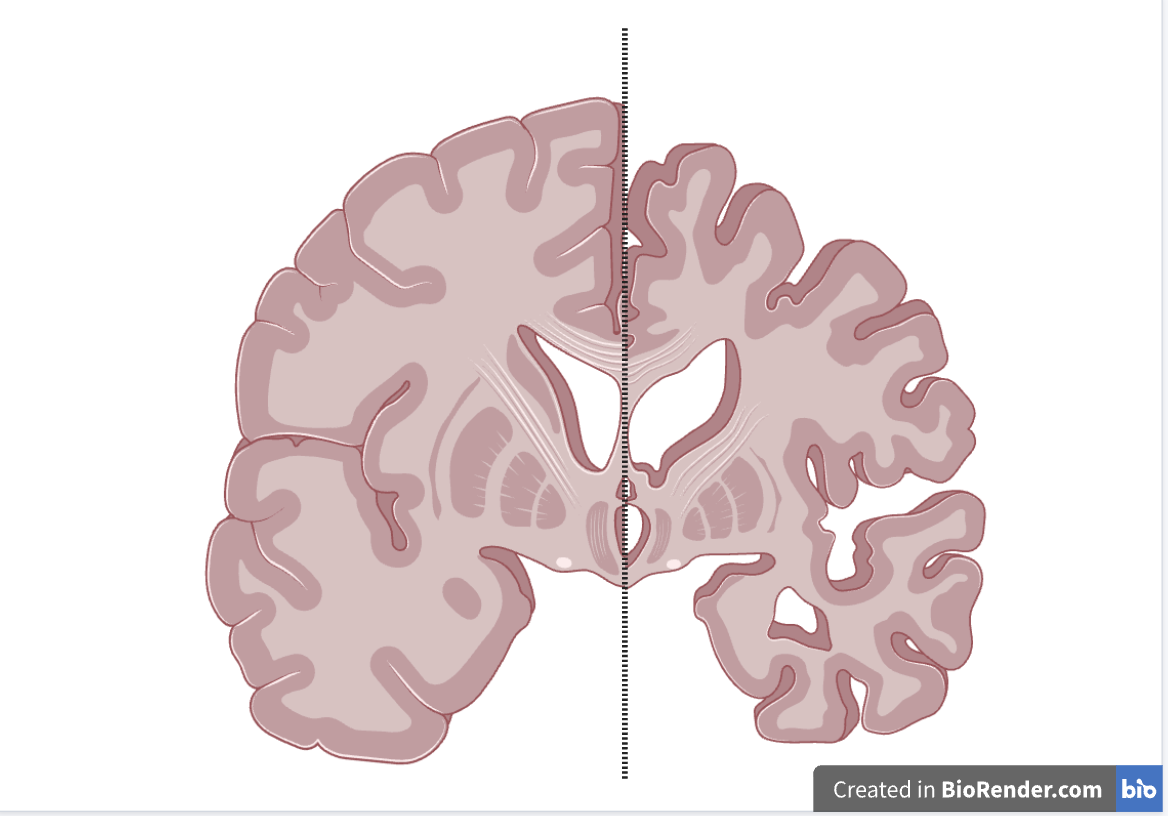Brain split into two halfs, one healthy and one representative of Alzheimer's disease